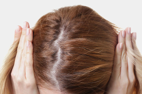 female pattern baldness